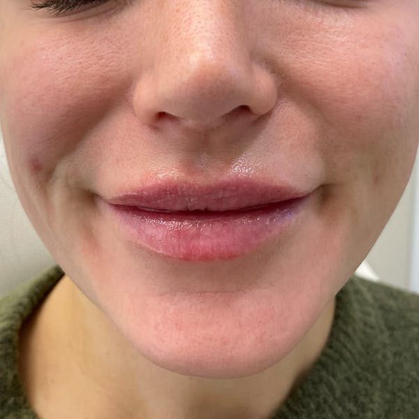 Lip Filler Before & After Gallery - Patient 365822 - Image 1