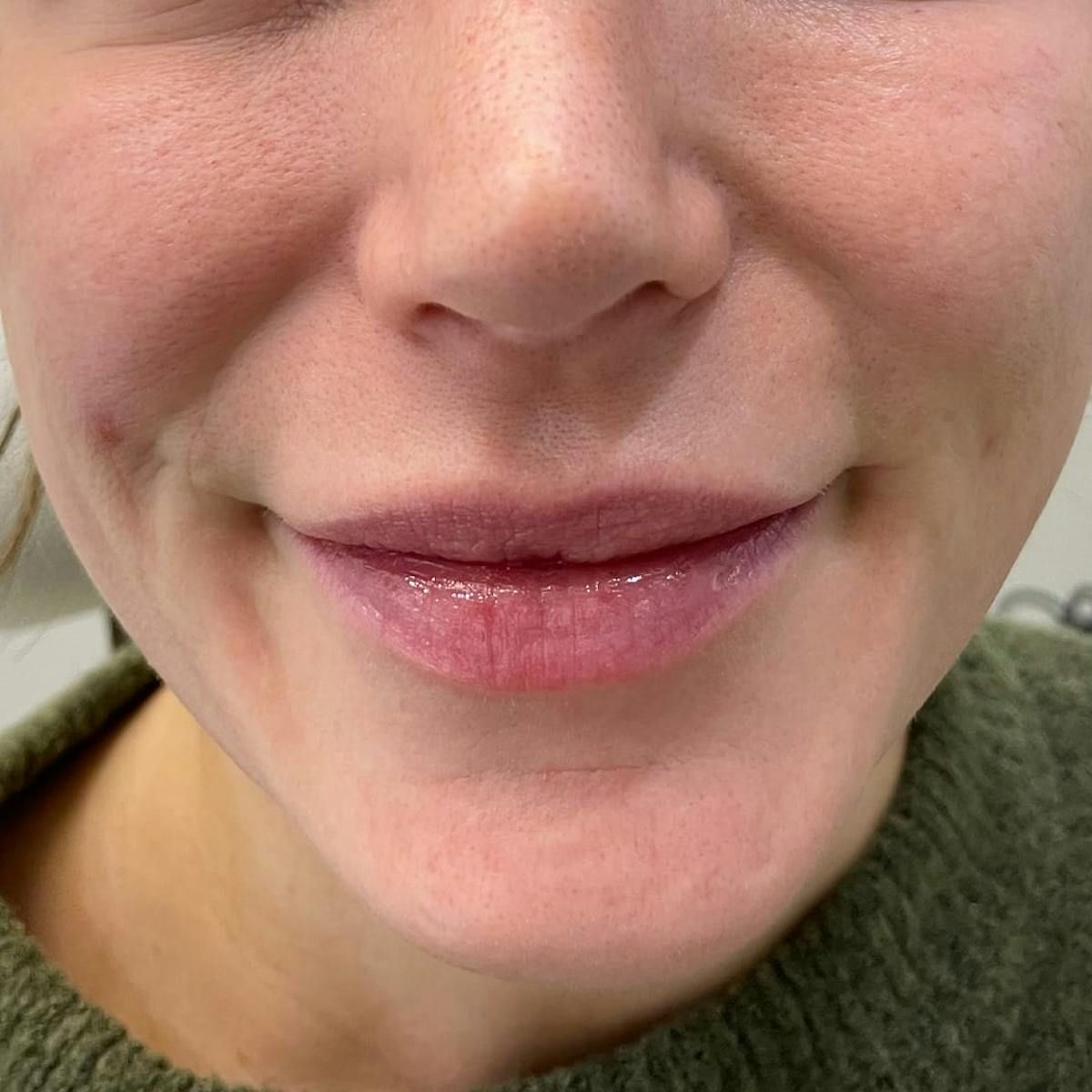 Lip Filler Before & After Gallery - Patient 365822 - Image 2