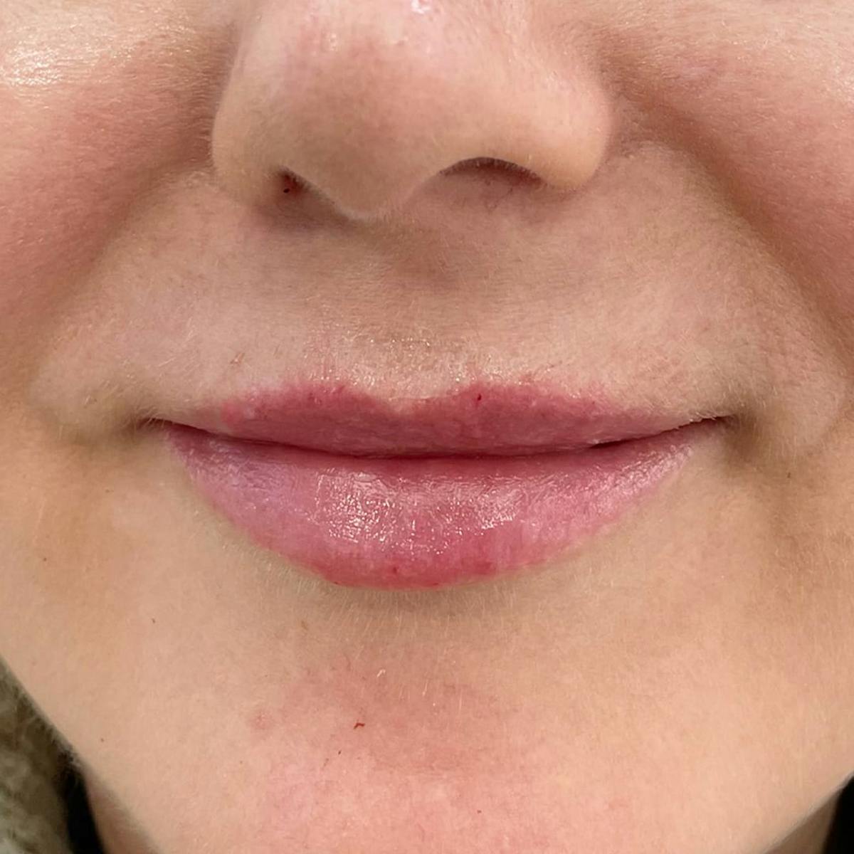 Lip Filler Before & After Gallery - Patient 305190 - Image 1