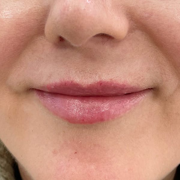 Lip Filler Before & After Gallery - Patient 305190 - Image 1