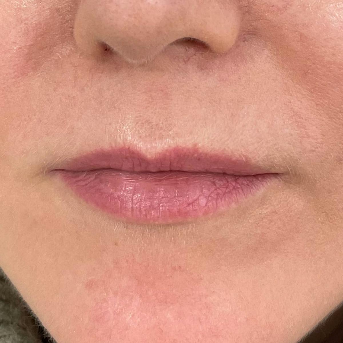 Lip Filler Before & After Gallery - Patient 305190 - Image 2