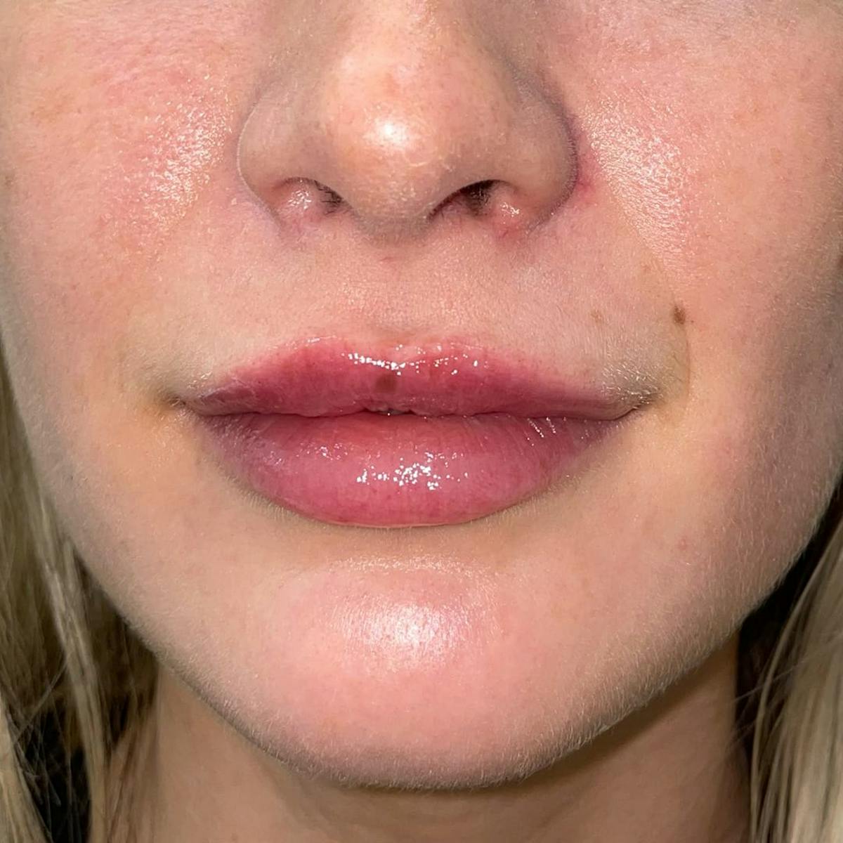 Lip Filler Before & After Gallery - Patient 341631 - Image 1