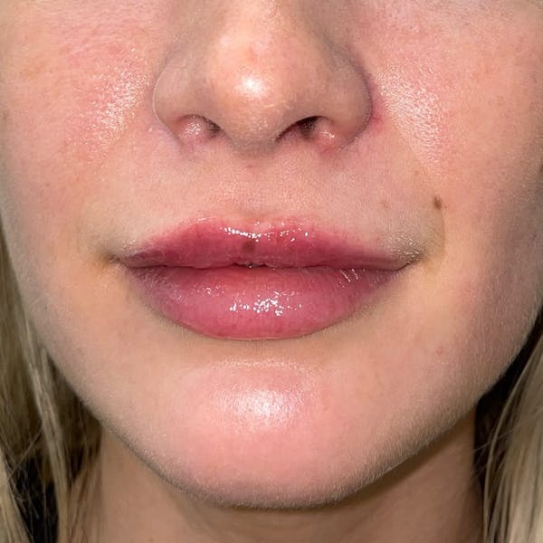 Lip Filler Before & After Gallery - Patient 341631 - Image 1