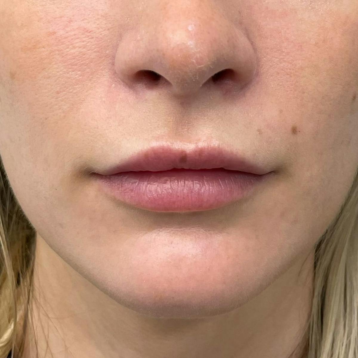 Lip Filler Before & After Gallery - Patient 341631 - Image 2