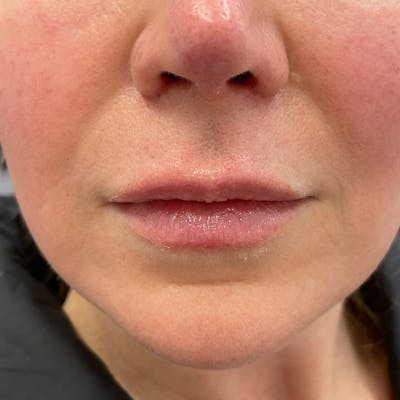 Lip Filler Before & After Gallery - Patient 212461 - Image 1
