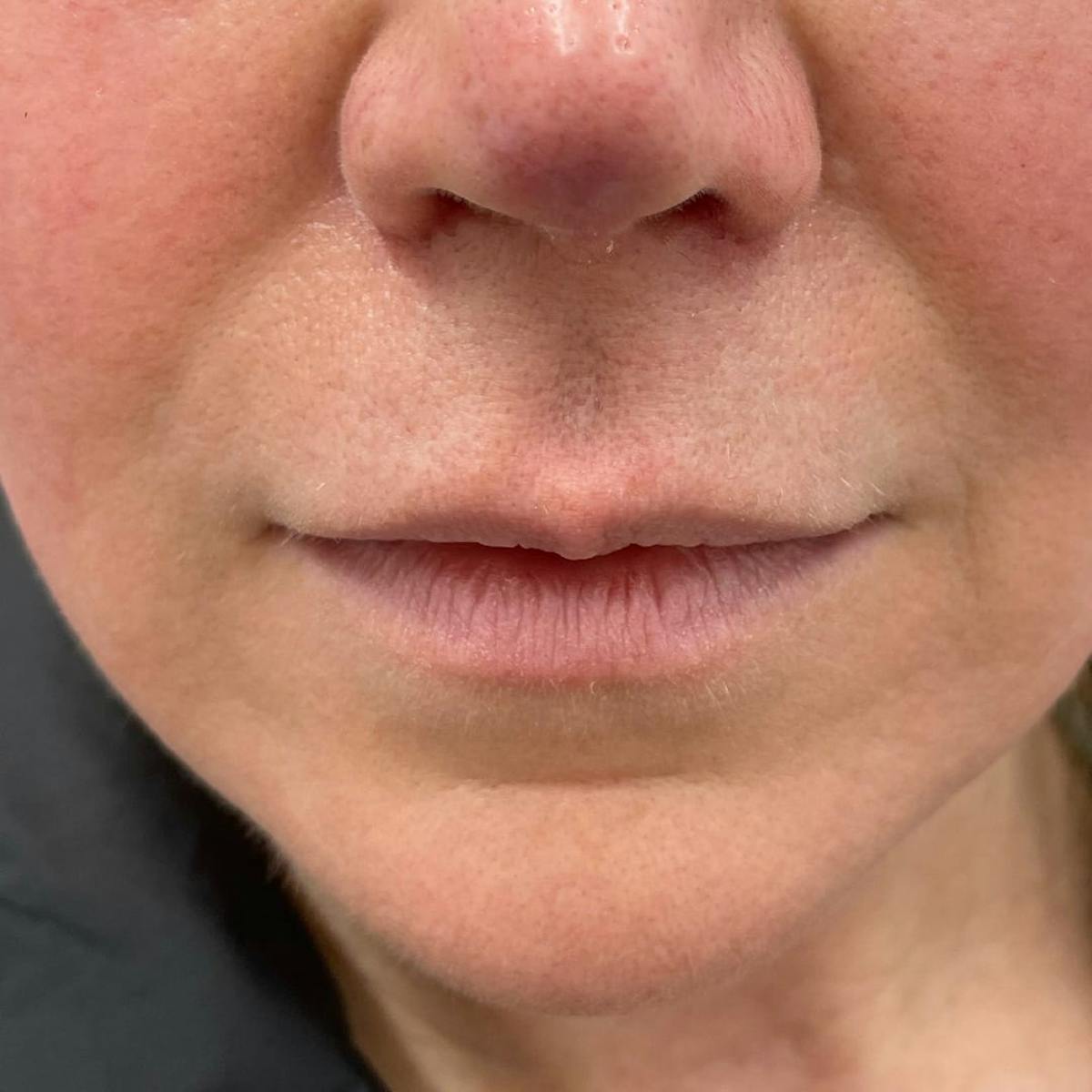 Lip Filler Before & After Gallery - Patient 212461 - Image 2