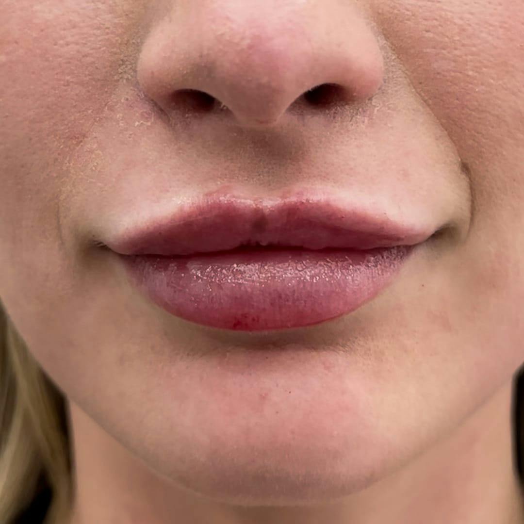 Lip Filler Before & After Gallery - Patient 849359 - Image 1