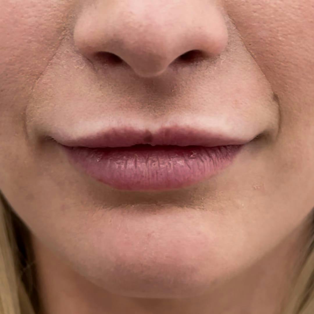 Lip Filler Before & After Gallery - Patient 849359 - Image 2