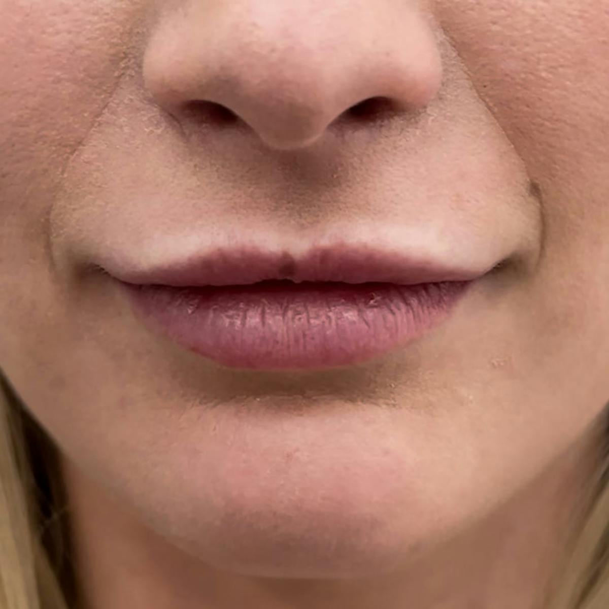 Lip Filler Before & After Gallery - Patient 849359 - Image 2