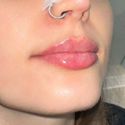 Lip Filler Before & After Gallery - Patient 286820 - Image 1