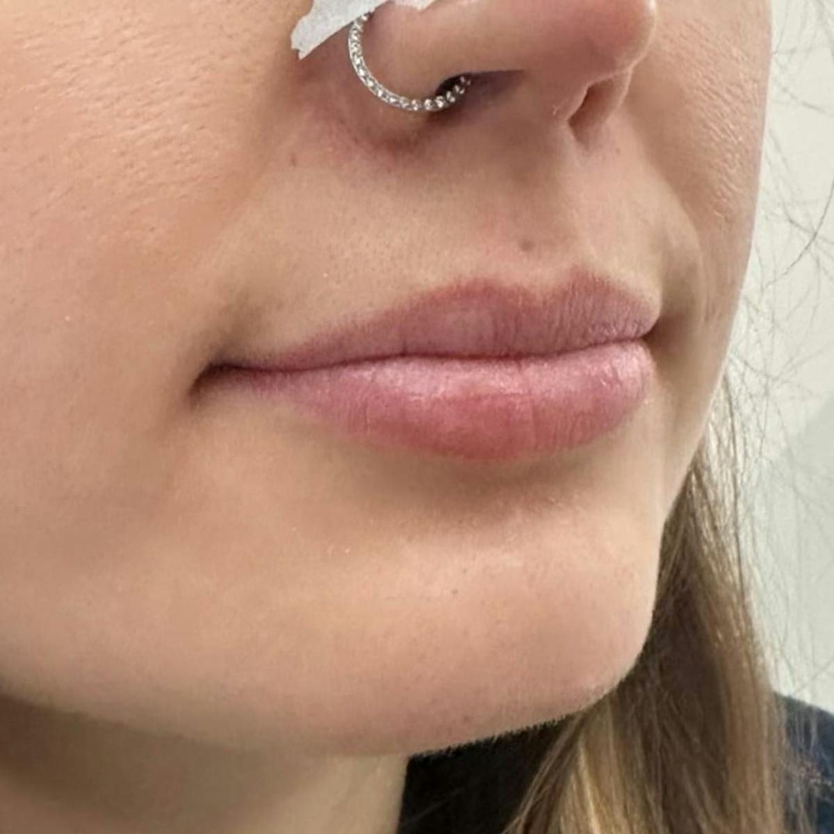 Lip Filler Before & After Gallery - Patient 286820 - Image 2