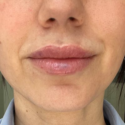 Lip Filler Before & After Gallery - Patient 775106 - Image 1