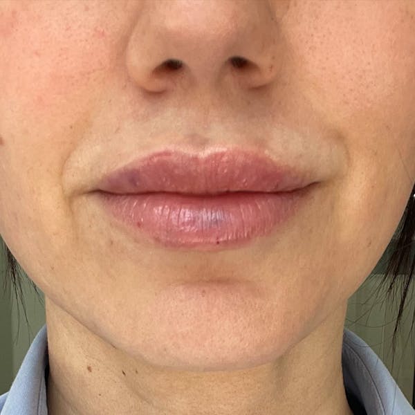 Lip Filler Before & After Gallery - Patient 775106 - Image 1