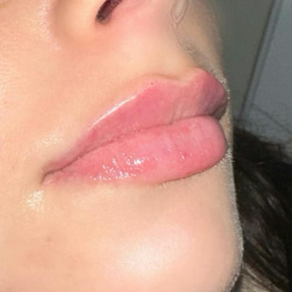 Lip Filler Before & After Gallery - Patient 279787 - Image 1