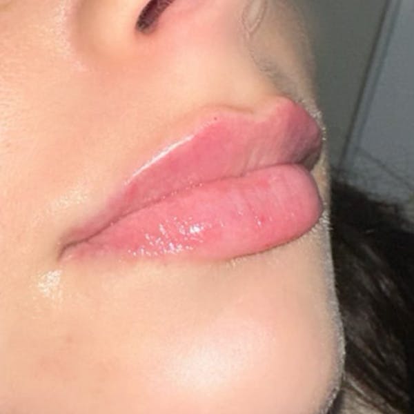 Lip Filler Before & After Gallery - Patient 279787 - Image 1