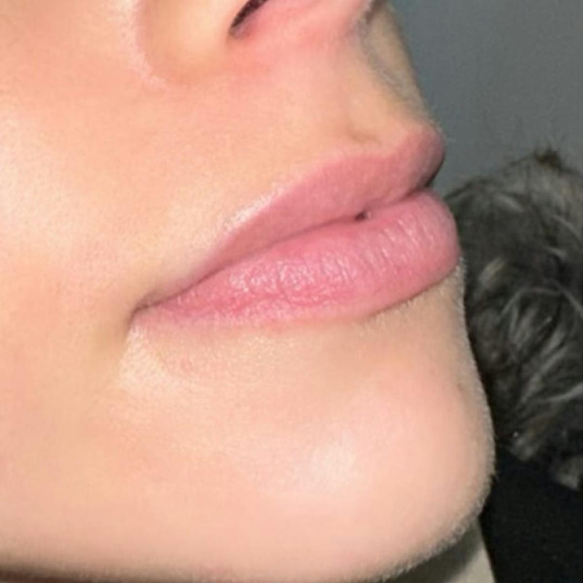 Lip Filler Before & After Gallery - Patient 279787 - Image 2