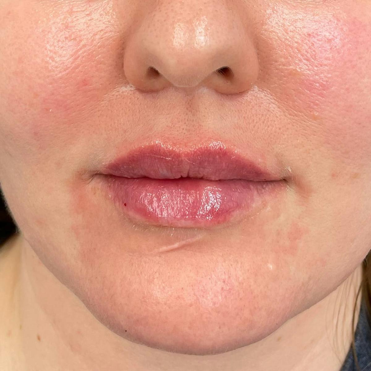 Lip Filler Before & After Gallery - Patient 369770 - Image 1