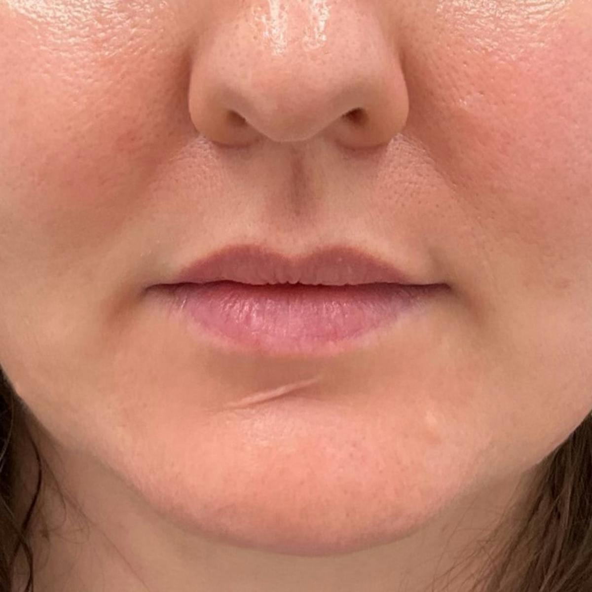 Lip Filler Before & After Gallery - Patient 369770 - Image 2