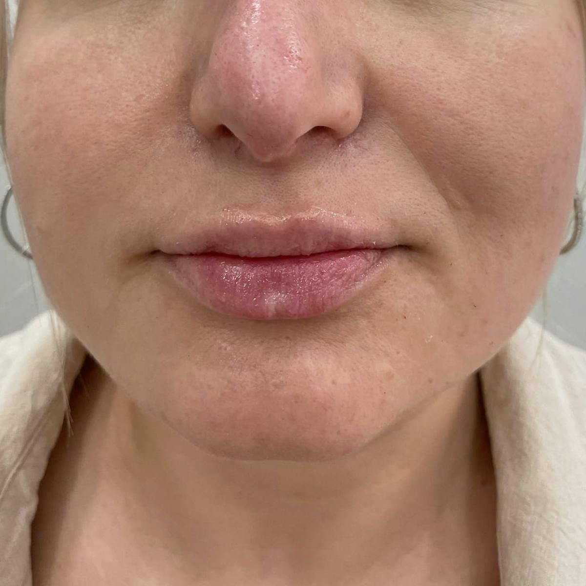 Lip Filler Before & After Gallery - Patient 229594 - Image 1