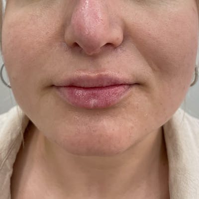 Lip Filler Before & After Gallery - Patient 229594 - Image 1