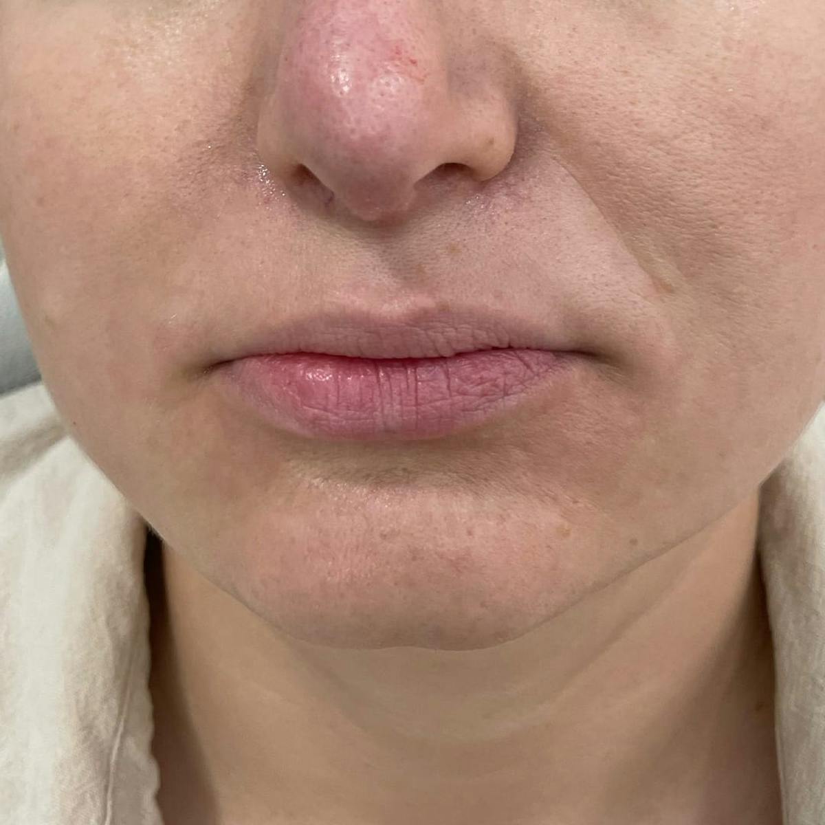 Lip Filler Before & After Gallery - Patient 229594 - Image 2