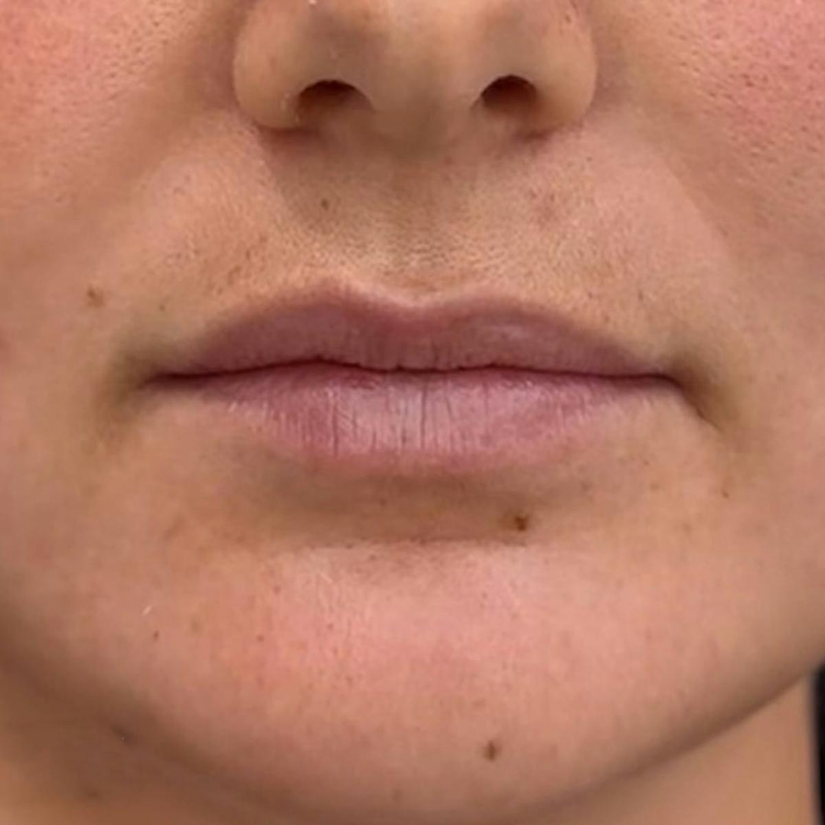 Lip Filler Before & After Gallery - Patient 824126 - Image 1