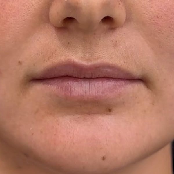 Lip Filler Before & After Gallery - Patient 824126 - Image 1