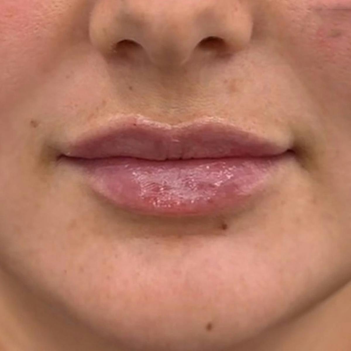 Lip Filler Before & After Gallery - Patient 824126 - Image 2