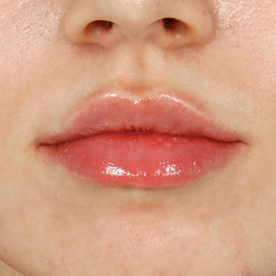 Lip Filler Before & After Gallery - Patient 285566 - Image 1