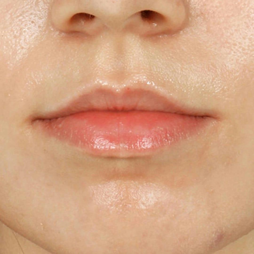 Lip Filler Before & After Gallery - Patient 285566 - Image 2