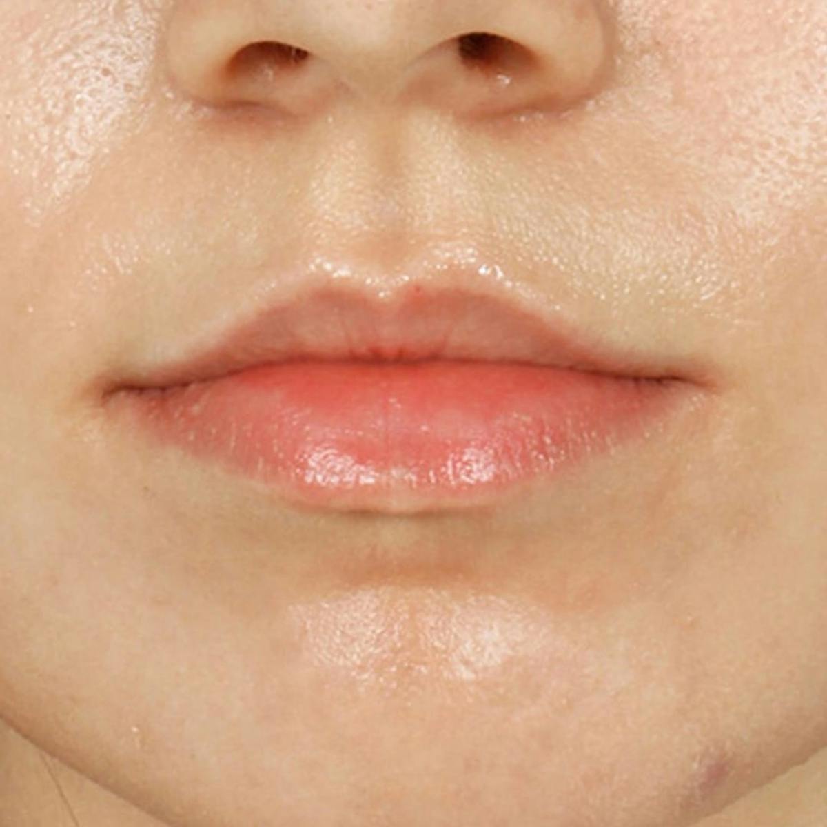 Lip Filler Before & After Gallery - Patient 285566 - Image 2