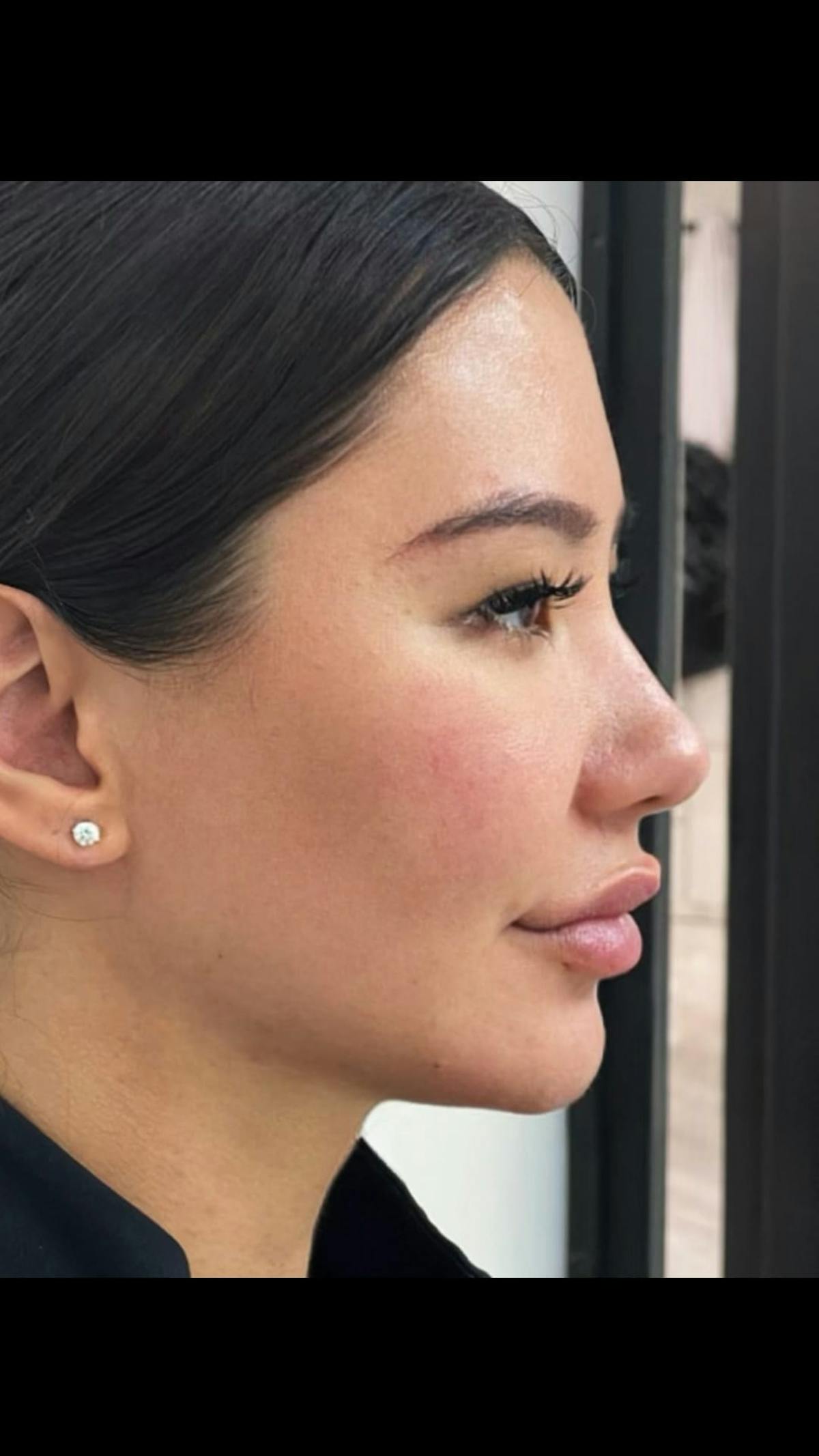 Jaw Filler Before & After Gallery - Patient 359885 - Image 1