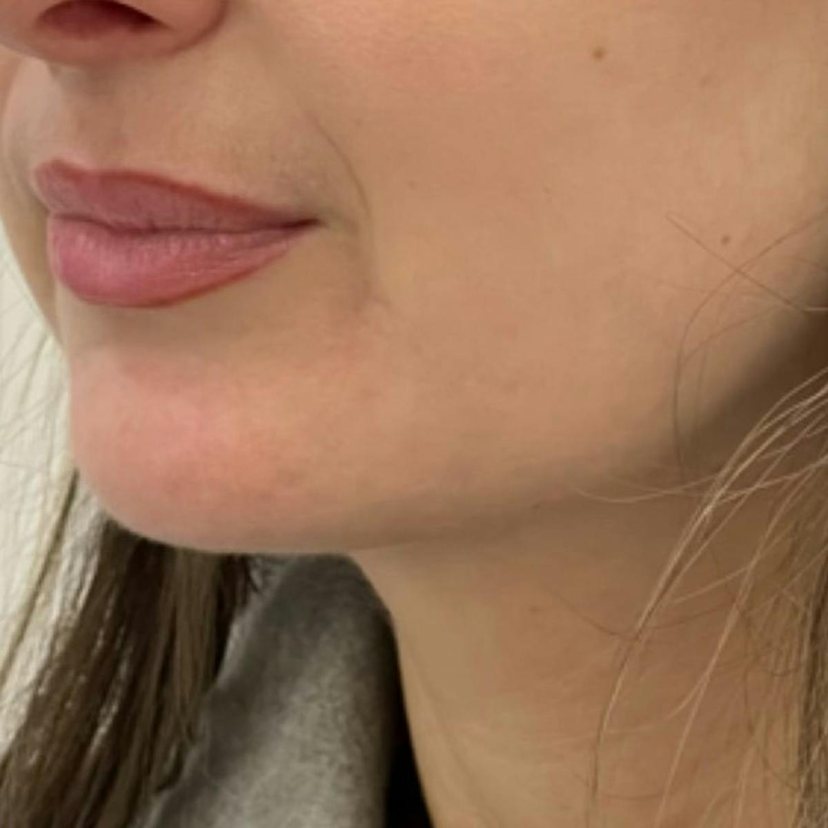 Jaw Filler Before & After Gallery - Patient 308923 - Image 1