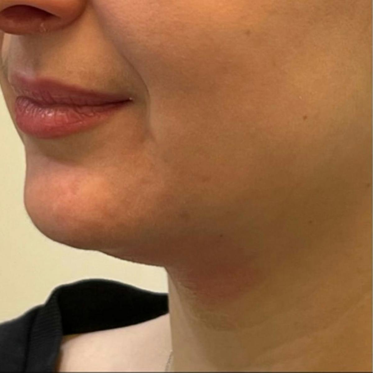 Jaw Filler Before & After Gallery - Patient 308923 - Image 2