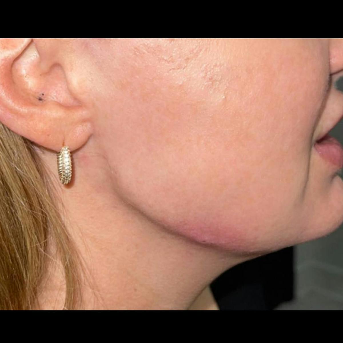 Jaw Filler Before & After Gallery - Patient 260216 - Image 1