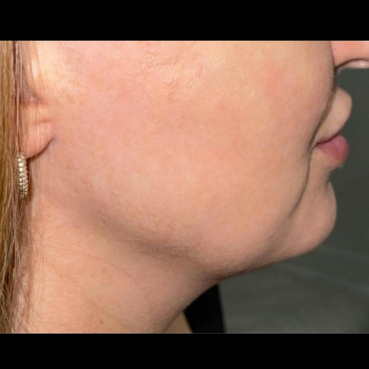 Jaw Filler Before & After Gallery - Patient 260216 - Image 2
