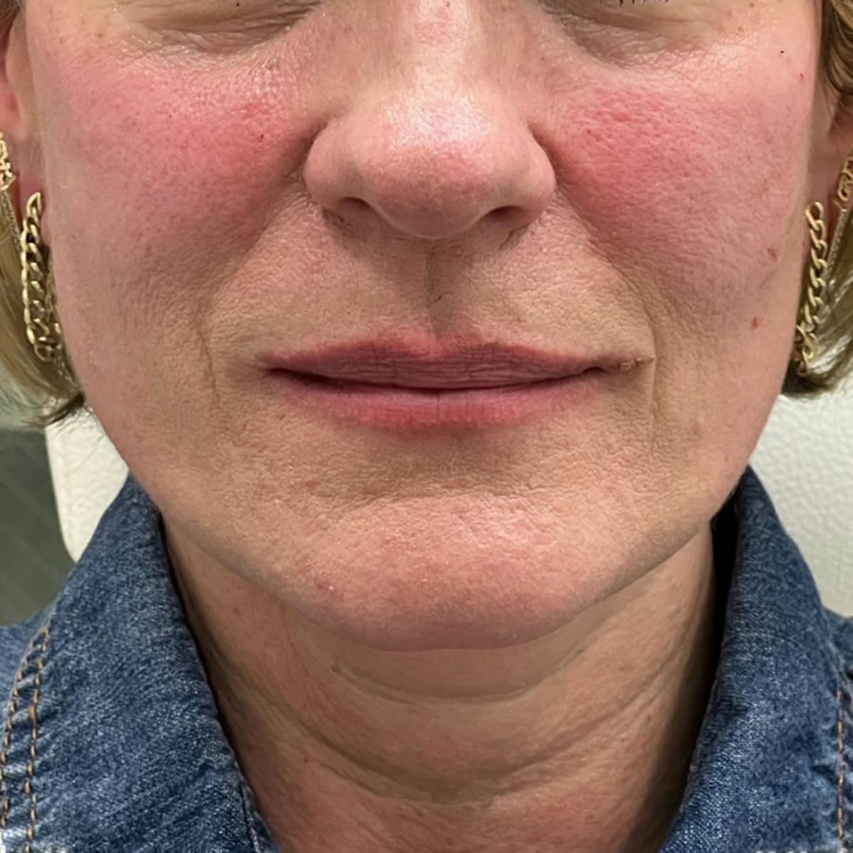 Cheek Filler Before & After Gallery - Patient 292363 - Image 1