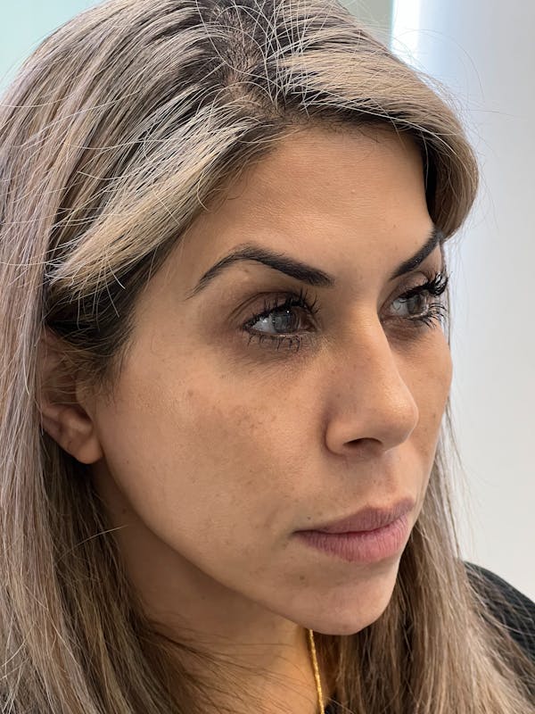 Cheek Filler Before & After Gallery - Patient 274363 - Image 1