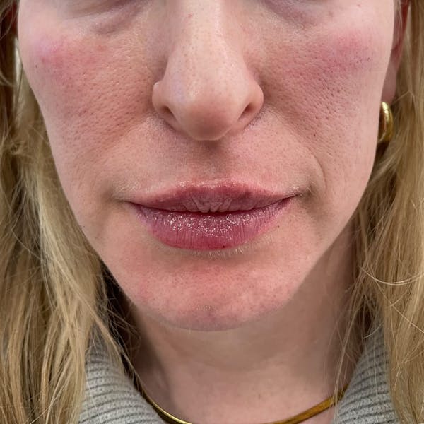 Cheek Filler Before & After Gallery - Patient 332772 - Image 1