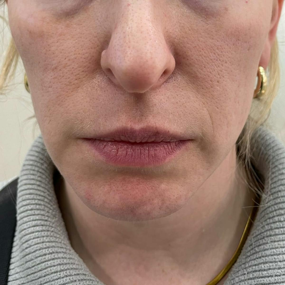 Cheek Filler Before & After Gallery - Patient 332772 - Image 2