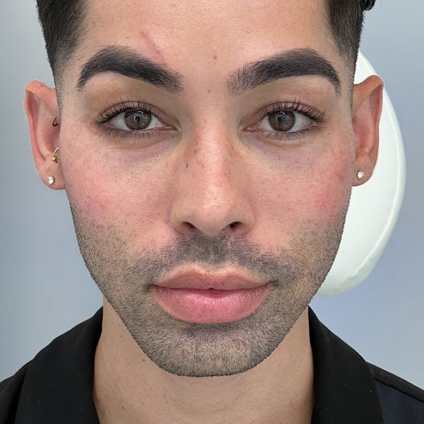 Cheek Filler Before & After Gallery - Patient 183487 - Image 1