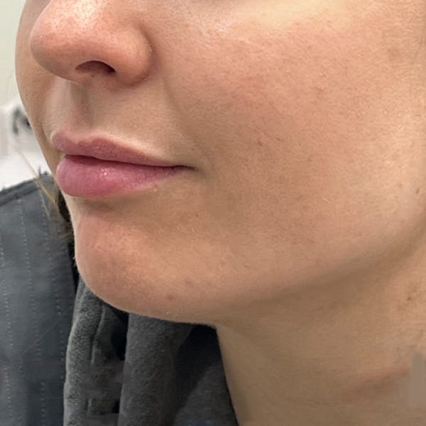 Chin Filler Before & After Gallery - Patient 123596 - Image 1