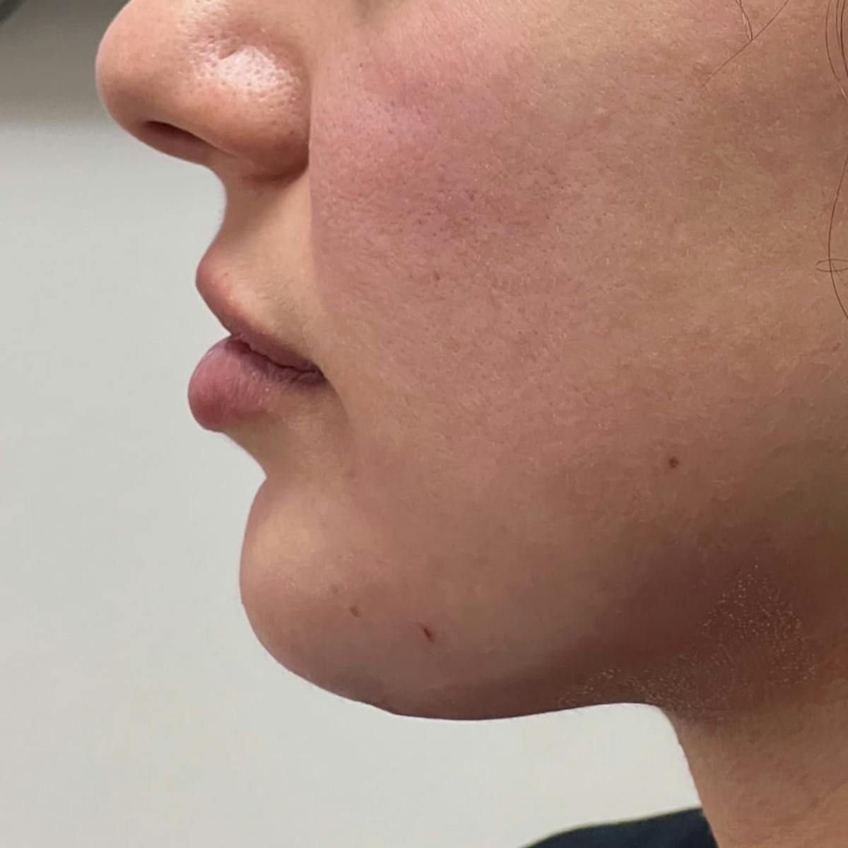 Chin Filler Before & After Gallery - Patient 328886 - Image 2