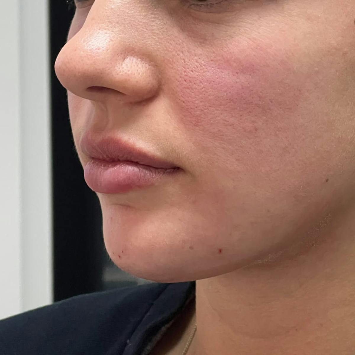 Chin Filler Before & After Gallery - Patient 328886 - Image 4