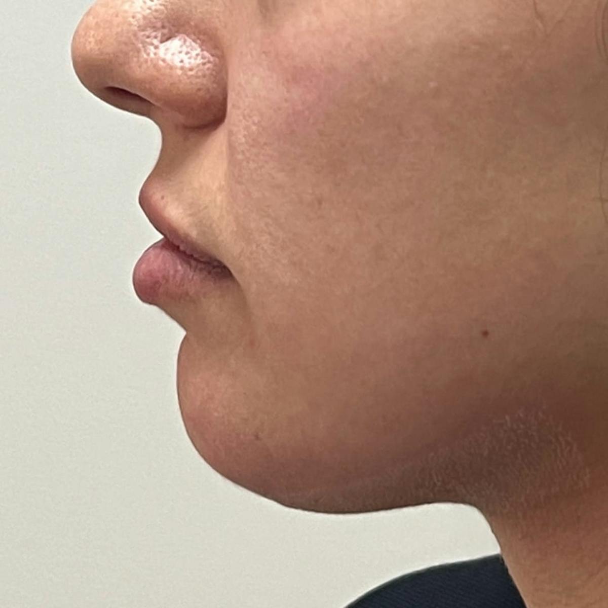 Chin Filler Before & After Gallery - Patient 328886 - Image 1
