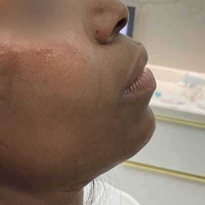 Chin Filler Before & After Gallery - Patient 409945 - Image 1