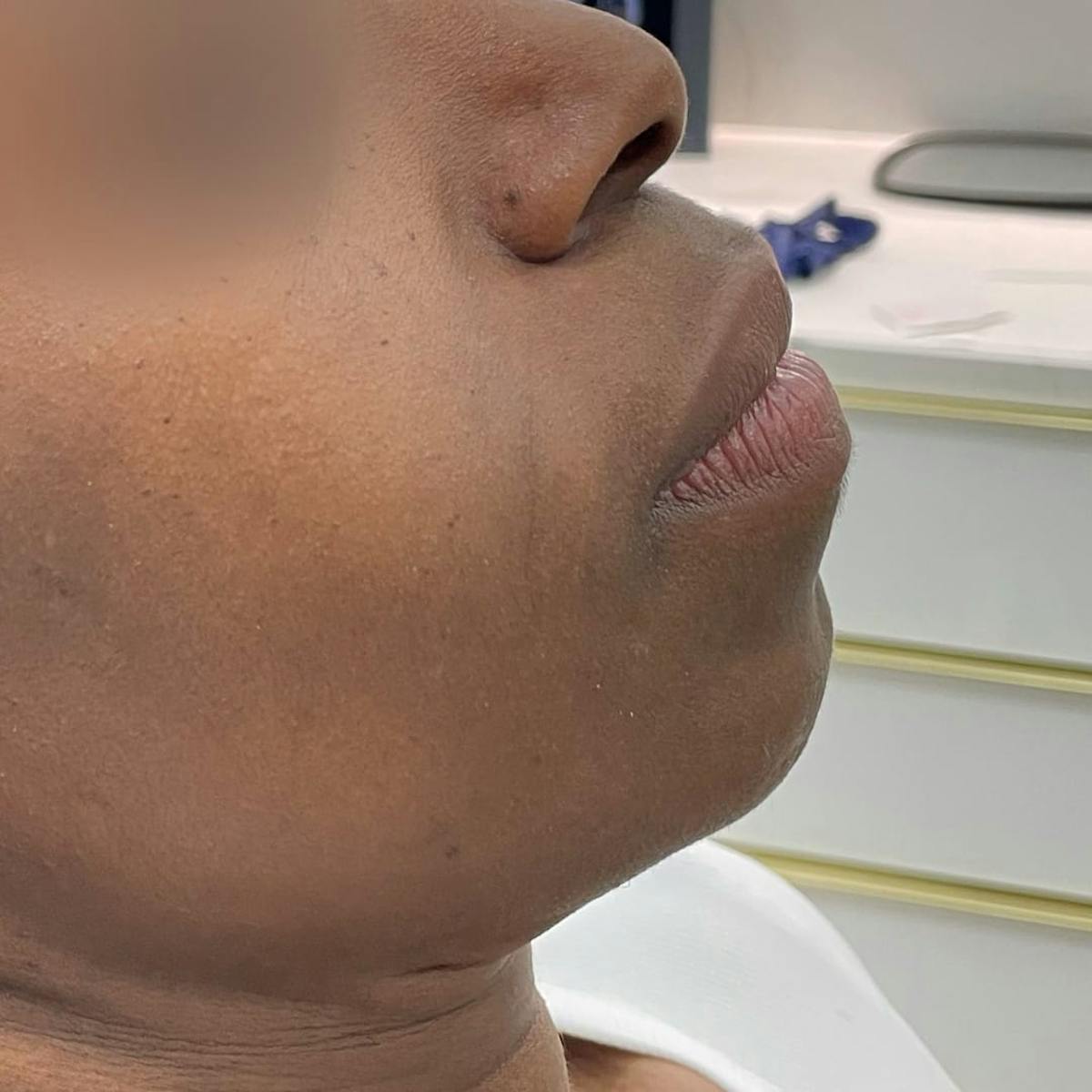 Chin Filler Before & After Gallery - Patient 409945 - Image 2
