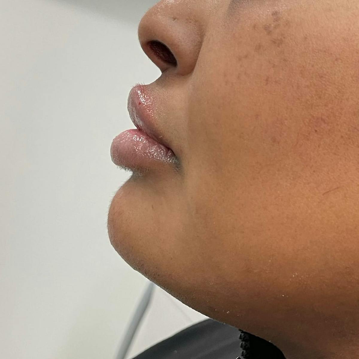 Chin Filler Before & After Gallery - Patient 224358 - Image 1