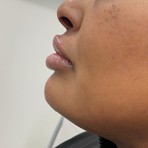Chin Filler Before & After Gallery - Patient 224358 - Image 1