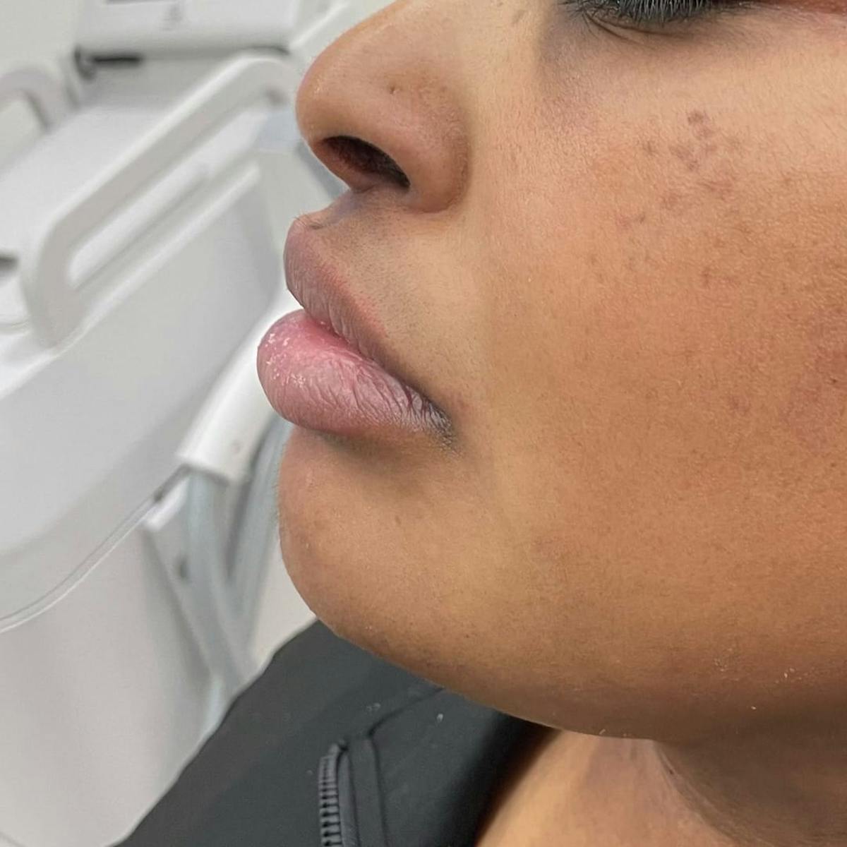 Chin Filler Before & After Gallery - Patient 224358 - Image 2
